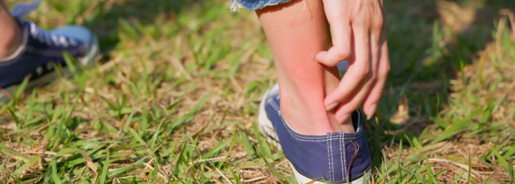 Understanding and Managing Mosquito Bite Allergies